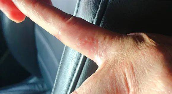 而是属于湿疹,所以又被称为"急性掌跖湿疹","汗疱性手