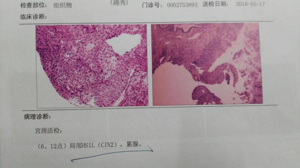 宫颈癌前病变cin1图片图片