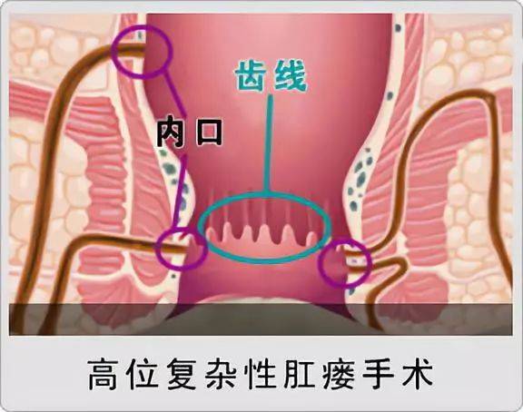 複雜性肛瘻是怎麼形成的