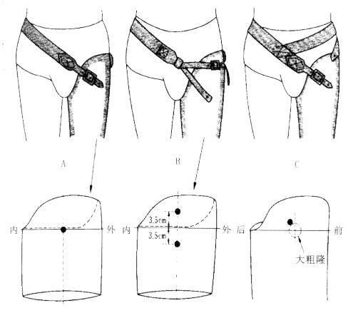 谈谈大腿假肢的接受腔