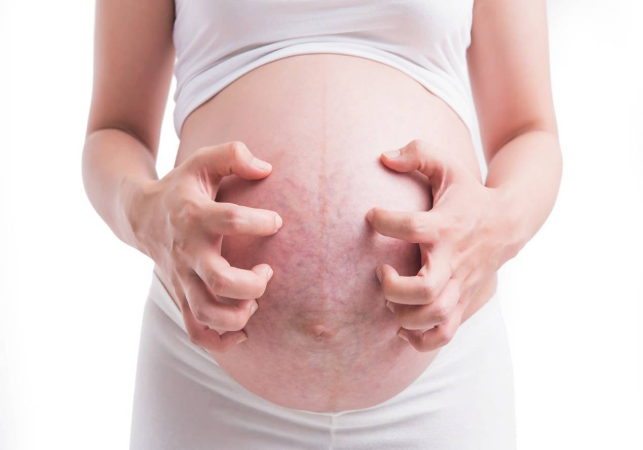 这些孕妇容易长妊娠纹,孕早期就要开始预防,一旦长了就很难消除