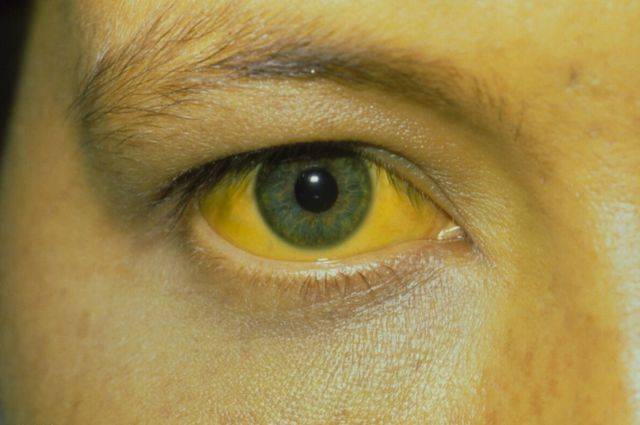 比较显著的一个症状了也比较好辨认和发现,如果是一段时间内眼白发黄
