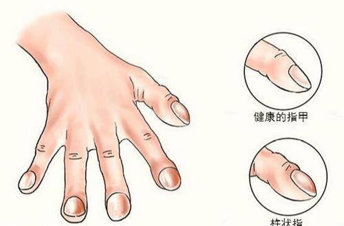 7,二尖瓣面容 有人说心脏疾病看脸能看出来.