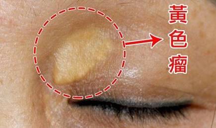 黄色瘤:相较于老年环,大家更熟悉黄色瘤,眼睑的黄色瘤,也叫睑黄疣.
