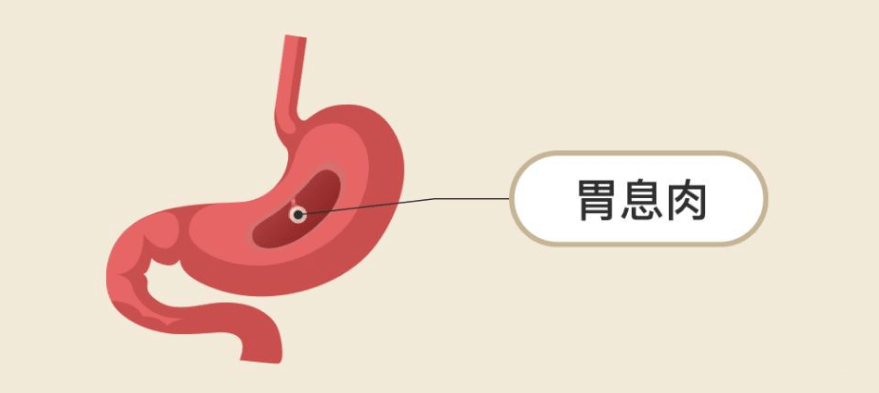 胃息肉:大多胃镜下就切了我如果长成这样,一定要切除五这么长的时间