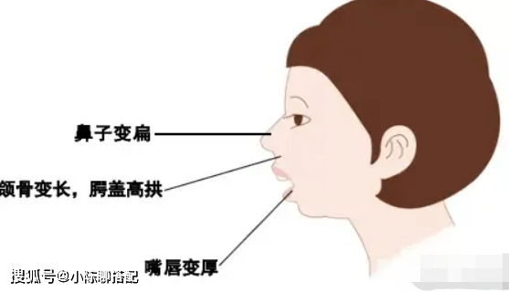 气流长期通过口腔冲击硬腭,使硬腭变形,高拱,造成上牙弓狭窄,而且上牙