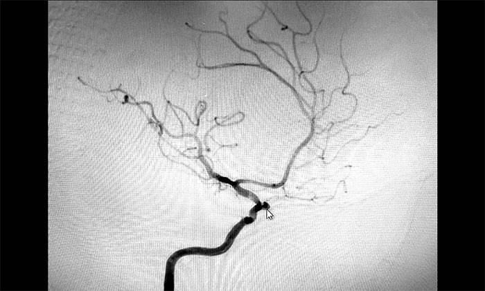 通过dsa全脑血管造影检查,发现患者右侧颈内动脉眼动脉段动脉瘤形成