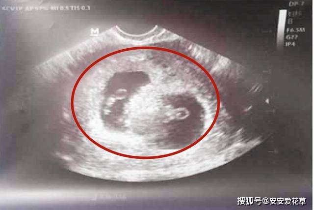 一个孕囊b超图图片