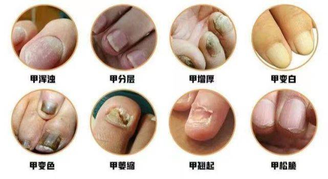 皮肤科专家的忠告:千万不要小瞧灰指甲!它危害远比你想象的大!
