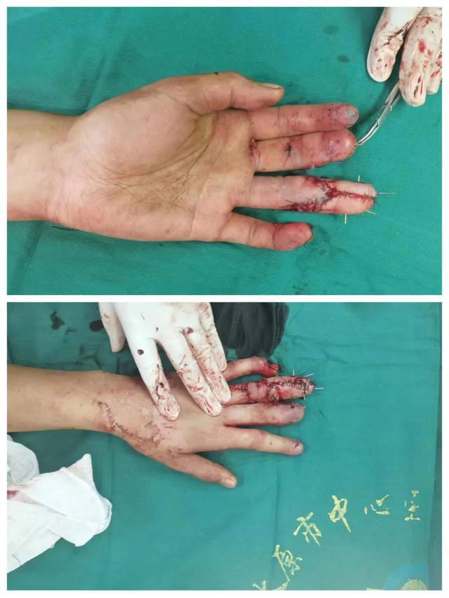 把脚趾移植到手上,太原一年轻男子断指重获新生!_手术_手指_王先生