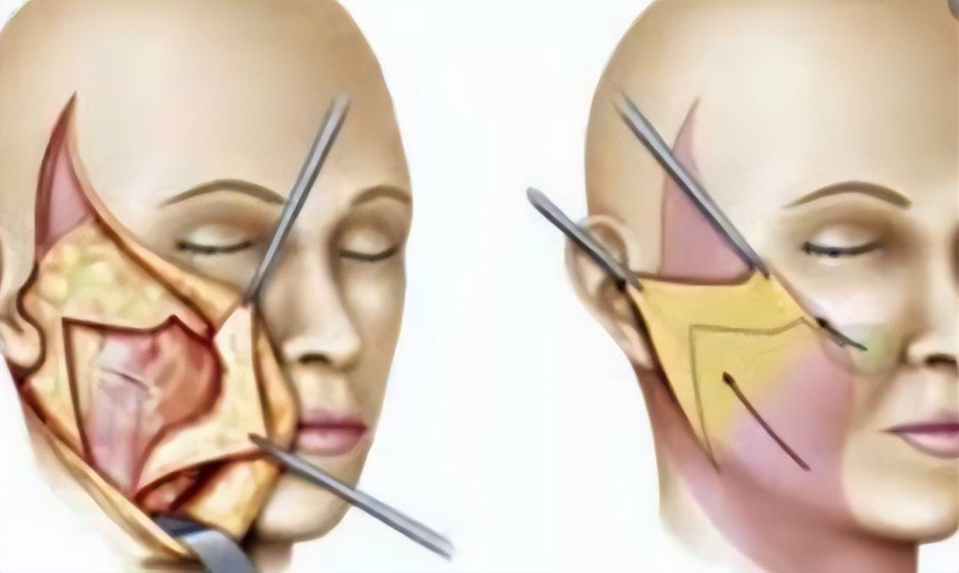 案例来了做完拉皮手术12天图片脸部手术拉皮真人图片