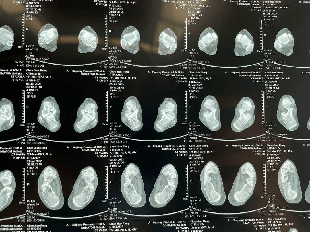 玖兆family | 优秀病例分享 天玑Ⅱ辅助下双侧跟骨骨折微创复位内固定