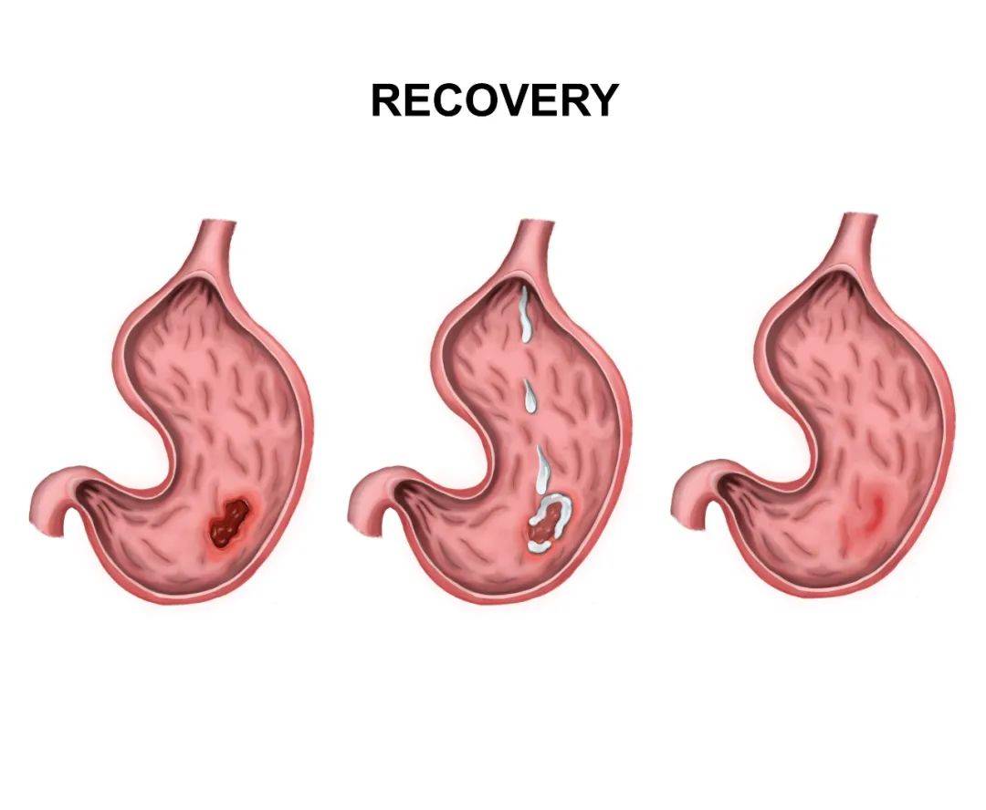 胃溃疡检查报告单图片