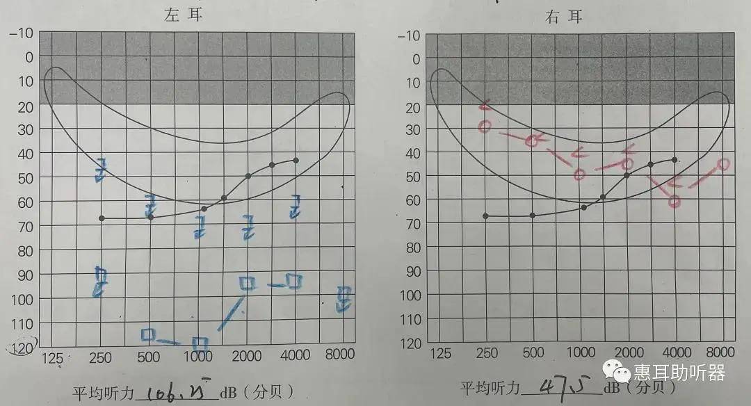 耳硬化症纯音测听图图片