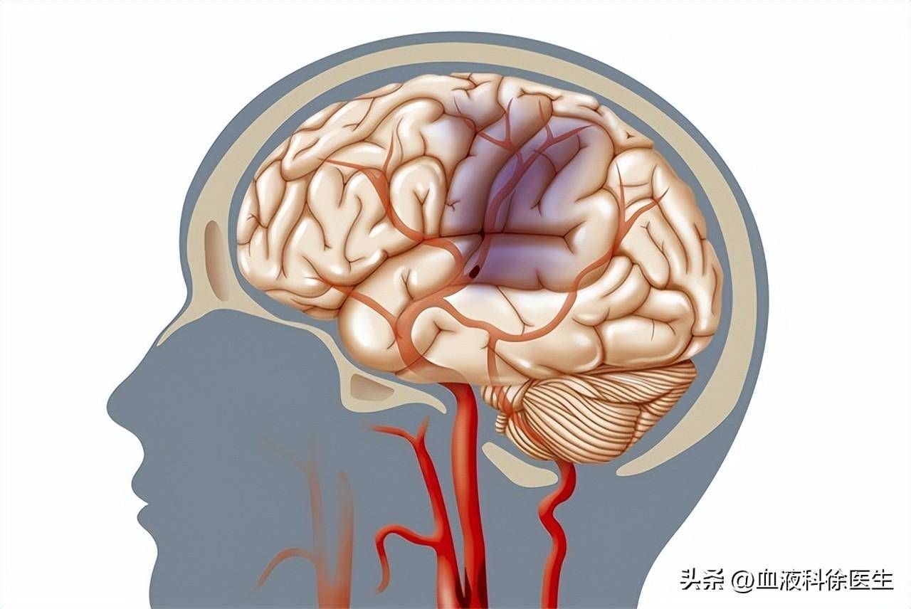 脑梗遗传图片