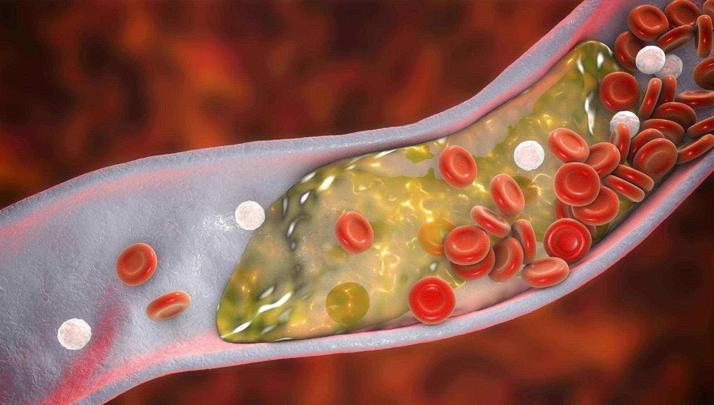 血脂高的人,若头部有4个现象,血液已"粘稠如粥",小心脑梗_血管_代谢