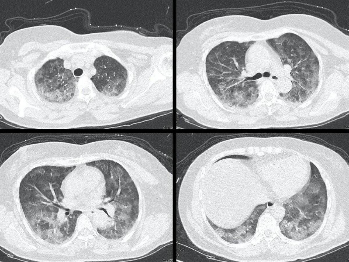 12岁男孩被诊断出白肺,提醒：阳康后出现3种情况,别不当回事