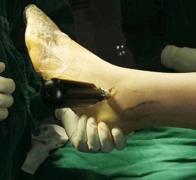 精准微创治疗平足症 让青少年"足"够完美_下关_手术_患儿