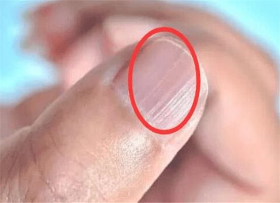 指甲有竖纹是什么病图片