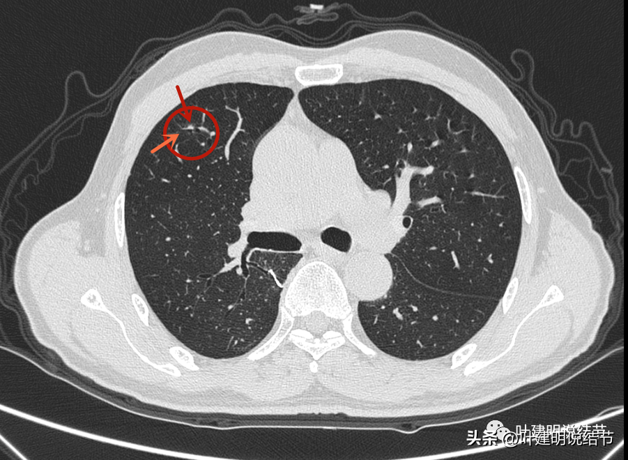 肺癌术后3年发现肺多发实性结节，我是如何准确判断不是转移的？