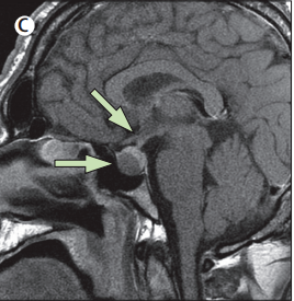 患者头皮上长出大脑沟回般的褶皱,提示一种起病隐匿的疾病!