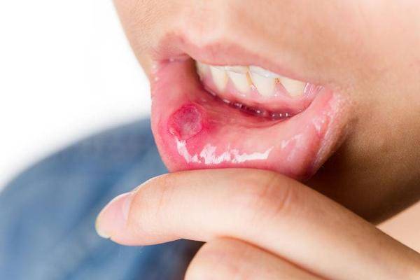 口腔溃疡反复发作,或与这5种因素有关,或有效避免口腔溃疡