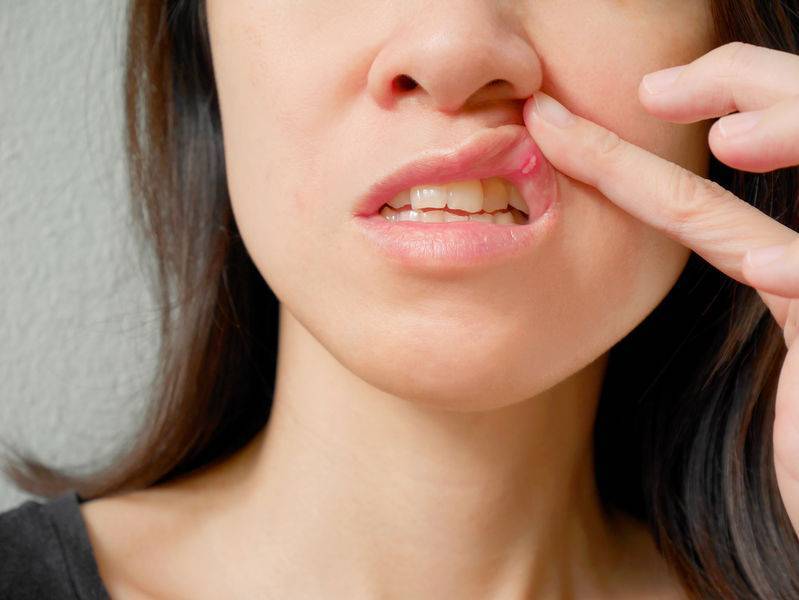口腔溃疡反复发作,或与这5种因素有关,或有效避免口腔溃疡