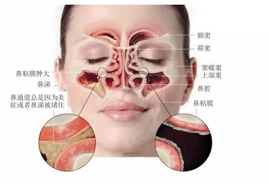 鼻粘膜肿胀如何消肿图片