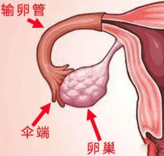 輸卵管遠端積水會導致卵巢病變嗎?_影響_治療_炎症