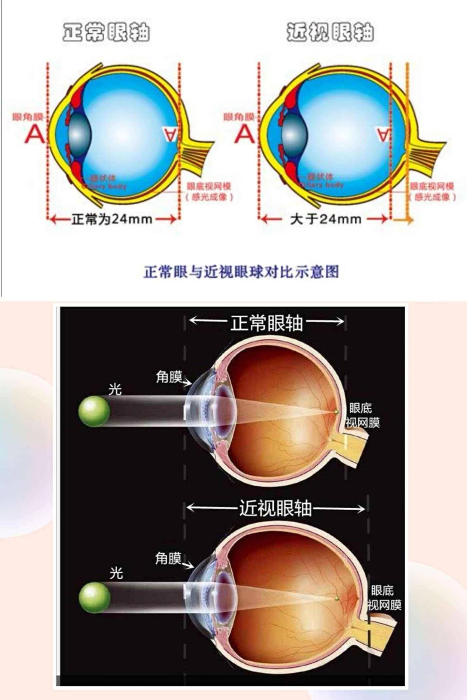 近视眼视网膜成像图图片