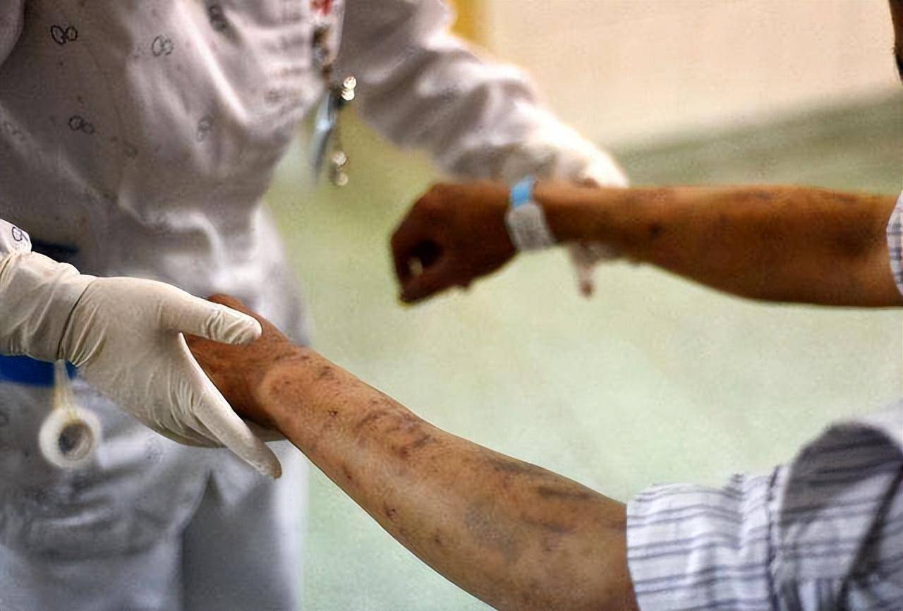 不要错把艾滋病当皮肤病,身体若有3变化,可能是艾滋病发出信号_症状