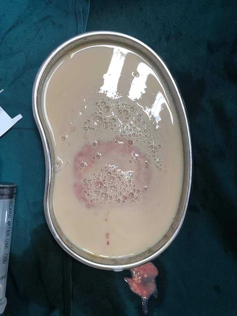 真菌,结核杆菌,医生有些头大,看来这不是感染导致的肝脓肿?