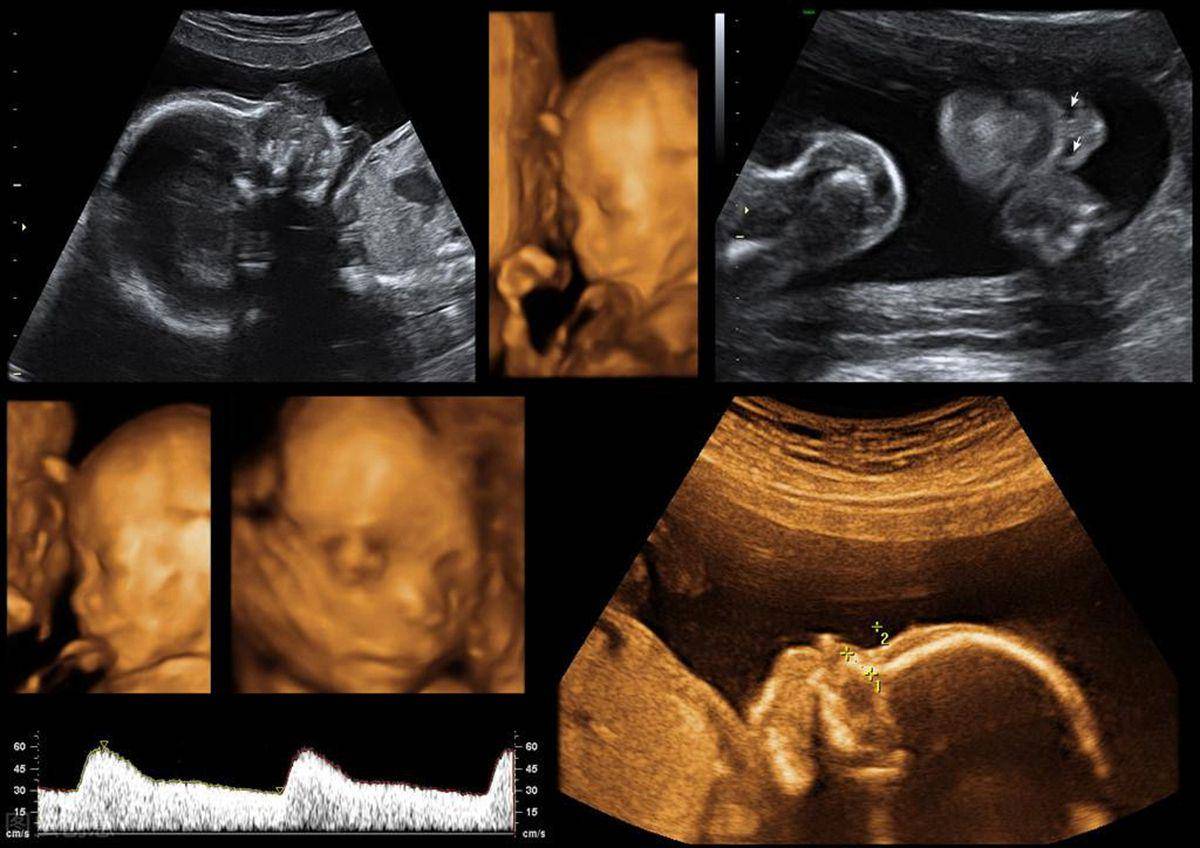 新生儿出生之后的样子为什么和四维图有所差异 产检有哪些好处