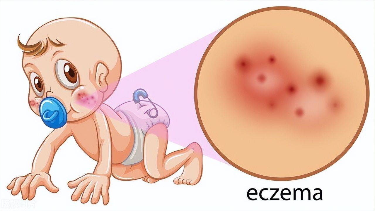 婴儿湿疹的治疗方法有哪些 如何预防宝宝湿疹