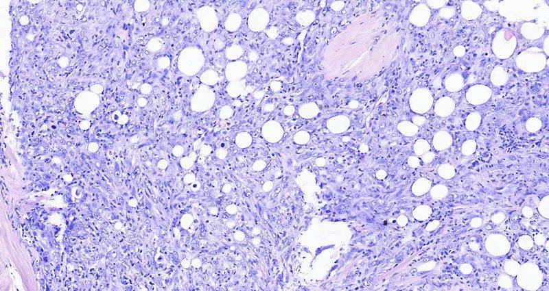 【病例分享】乳腺高级别双相化生性癌1例_细胞_肿瘤_上皮