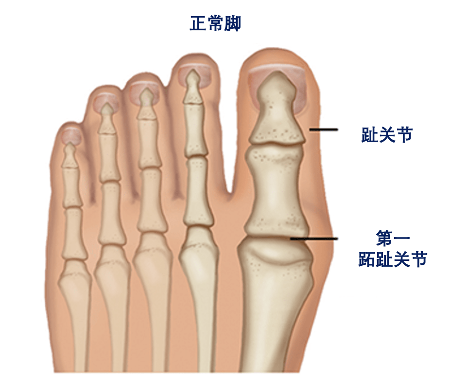 但这个角度就很小,各跖趾关节对合整齐才是正常的,拇趾也没有向第二