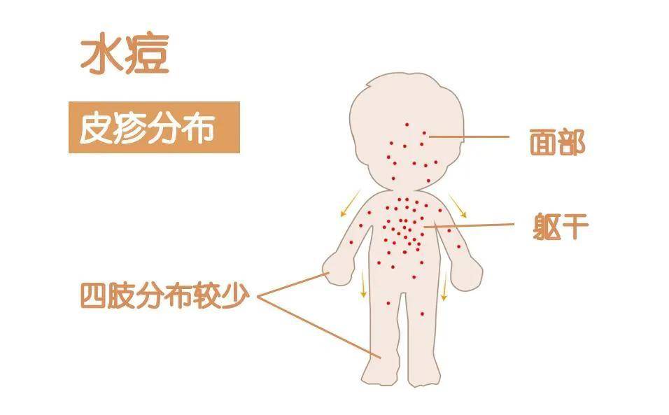 家長注意了,水痘進入高峰期!一文帶你瞭解水痘的防治_傳播_患兒_丘疹