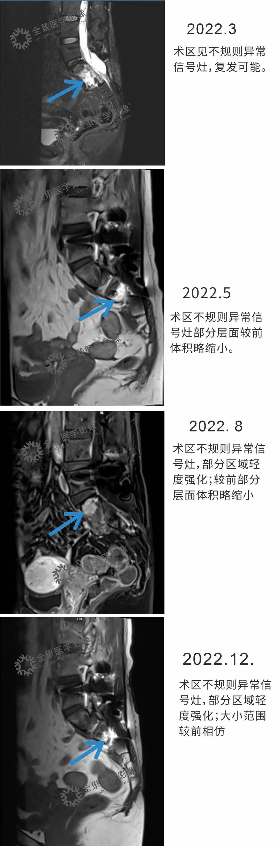 尾骨肿瘤图片