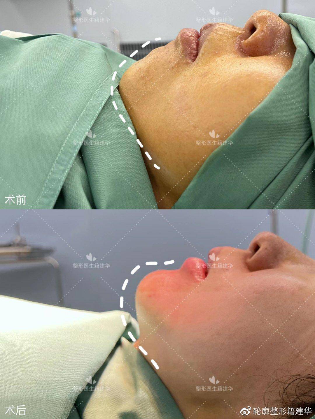 颏成型和假体哪个更好?术后注意事项有哪些?_脸型_效果_永久性