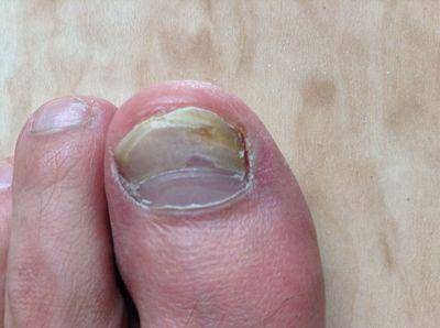 很严重的灰指甲能治好吗?_治疗_进行_处理