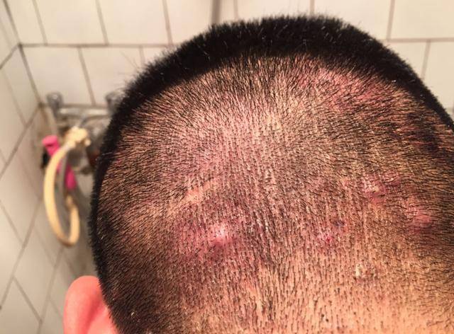 为什么头皮上经常长脓包和疙瘩?
