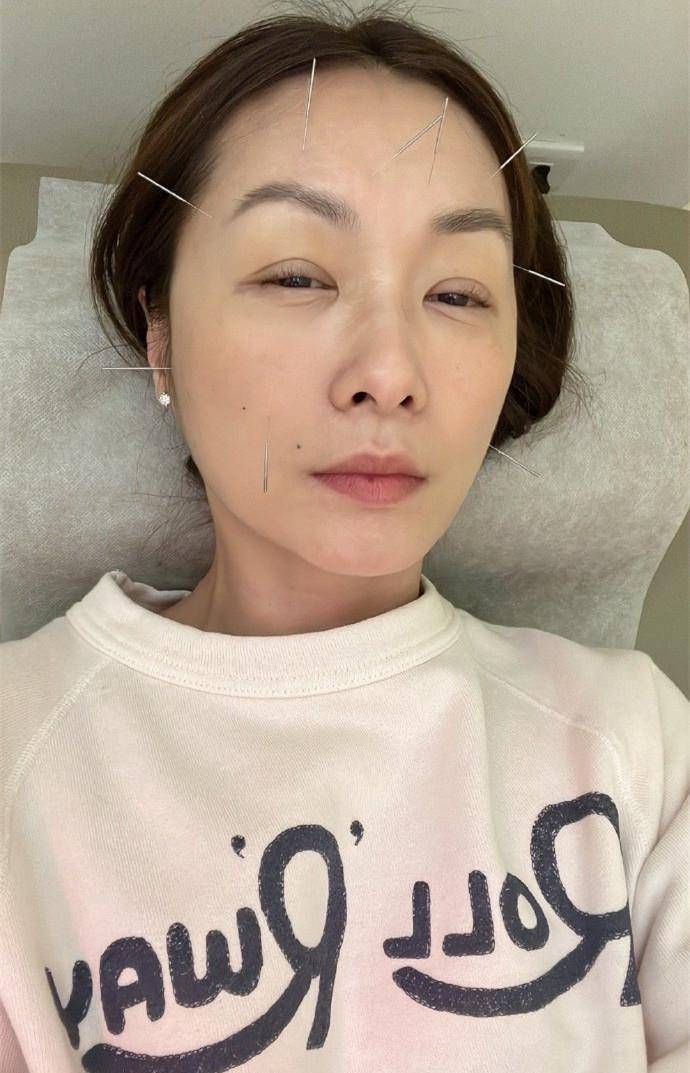 只见她躺着做针灸,她的脸上被扎满了针,乍一看有点吓人.