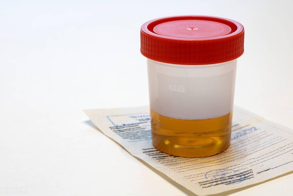 早上尿液发黄是怎么回事?李医生:不同颜色,不同症状_男性_肾脏_诊断