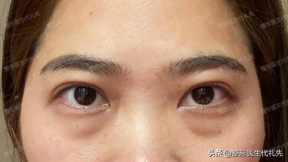 40岁眼袋外切照片图片