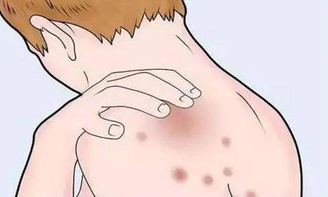 皮肤总是过敏荨麻疹，冬春季节变化