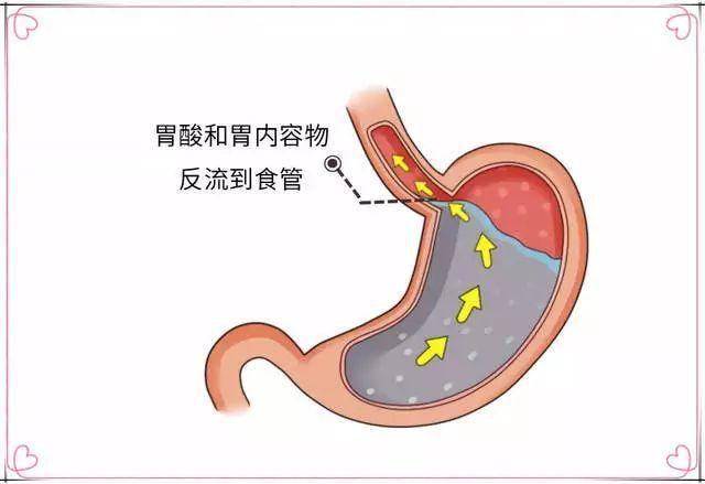 西醫對 gerc 的主要治療方法以抗反流藥物治療為主,例如應用抑酸劑