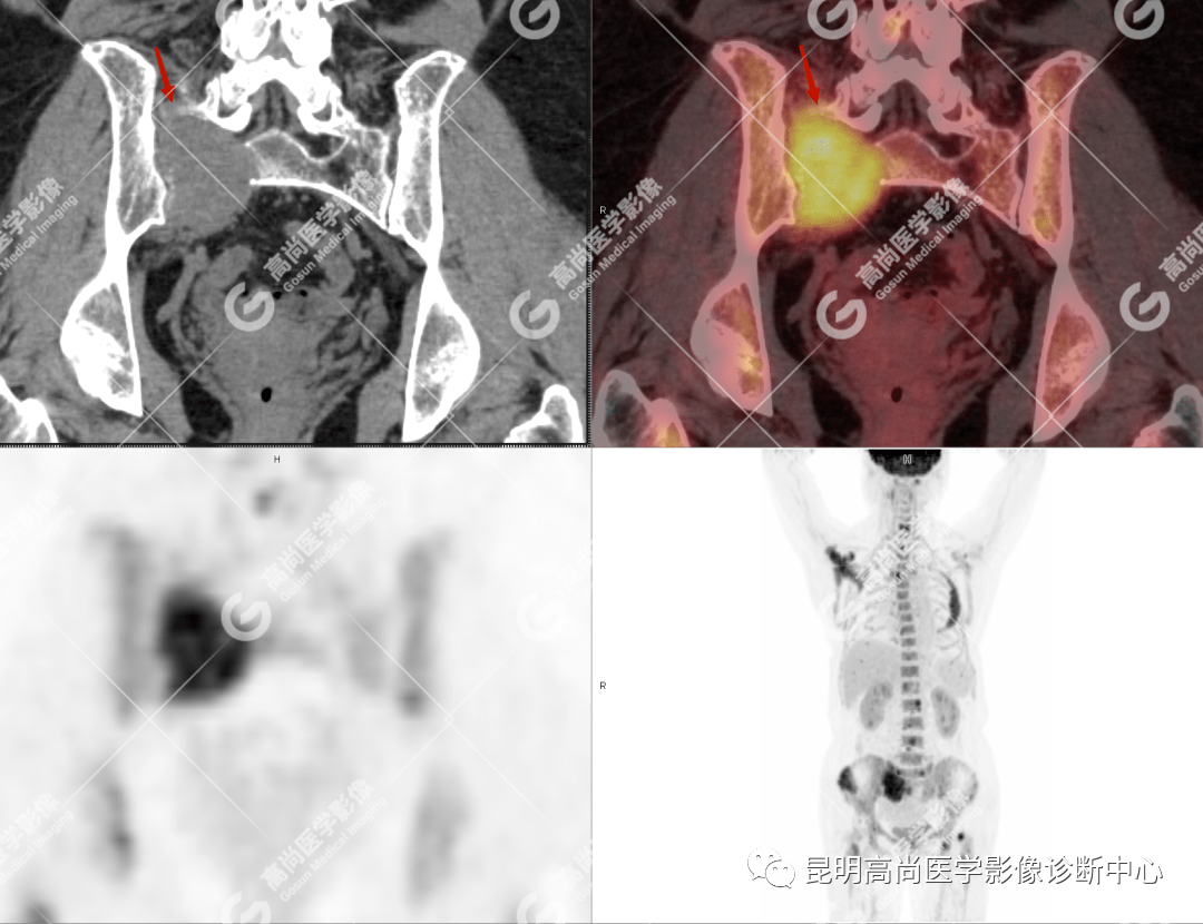 肩胛骨-骨窗)pet-ct(右側肩胛骨-骨窗)pet-ct(右側肩胛骨-軟窗)pet-ct