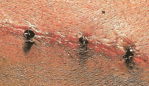 印度和南美洲的一些部落会将白蚁或金龟子放在伤口边缘,趁它们咬人的