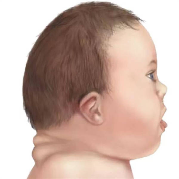 二十一三体综合症婴儿图片