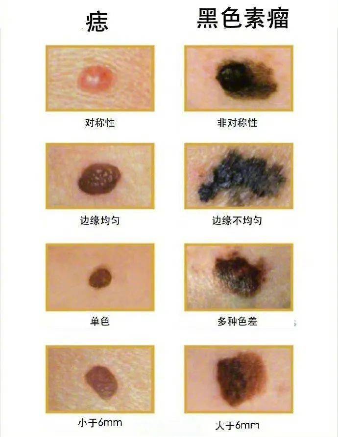 黑色素瘤是皮肤恶性肿瘤之一,恶性程度高,转移速度快
